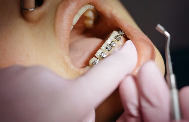 A reabilitação dentária com implantes ortodônticos permite melhorias na função mastigatória, evitando assim a evolução de doenças (Cottonbro Studio/Pexels)
